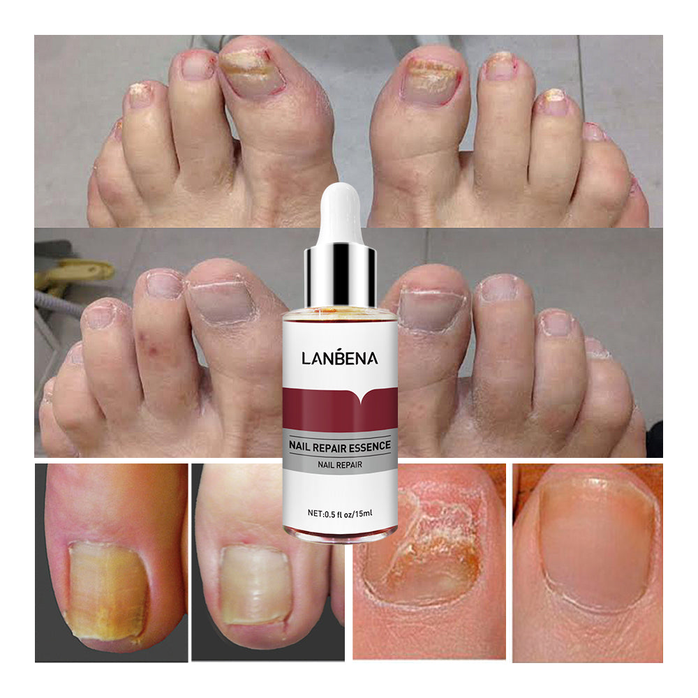 Sérum de réparation des ongles, Gel Anti-Infection