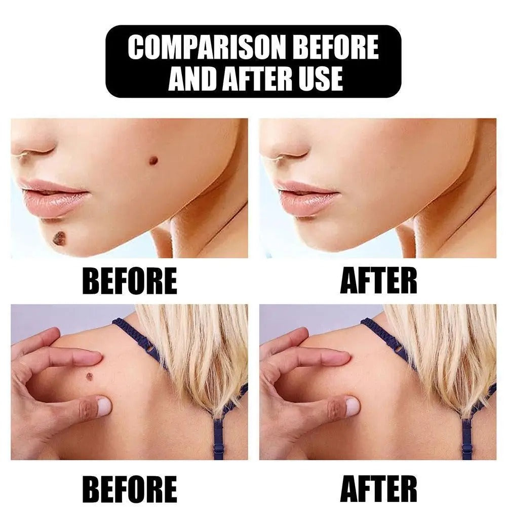 Dissolvant de taches brunes pour le corps, soin de la peau du visage