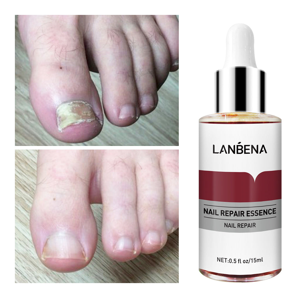 Sérum de réparation des ongles, Gel Anti-Infection