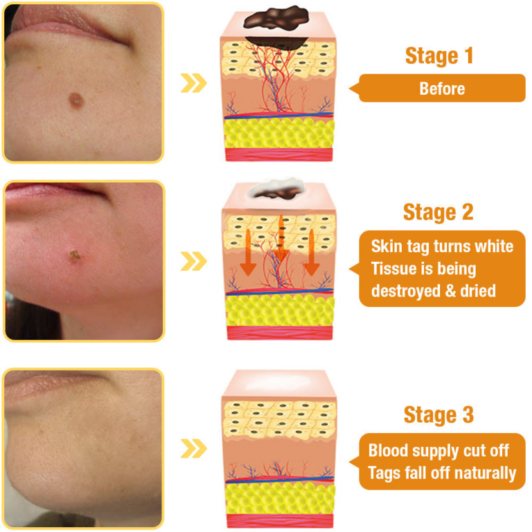 Crème de traitement contre les taupes et les verrues Brezey™ Bee Venom Mole