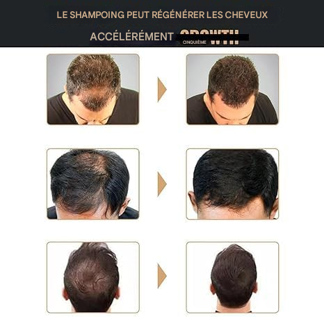 ✨Shampoing anti-chute, activateur de racines pour cheveux