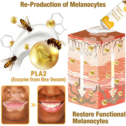 Fivfivgo™ Crème de traitement BeeVenom Vitiligo