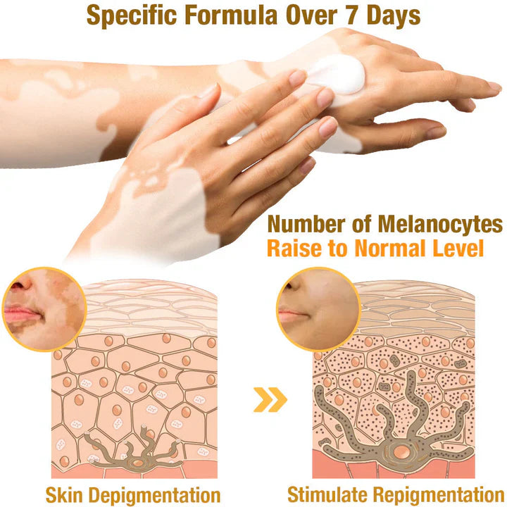 Fivfivgo™ Crème de traitement BeeVenom Vitiligo