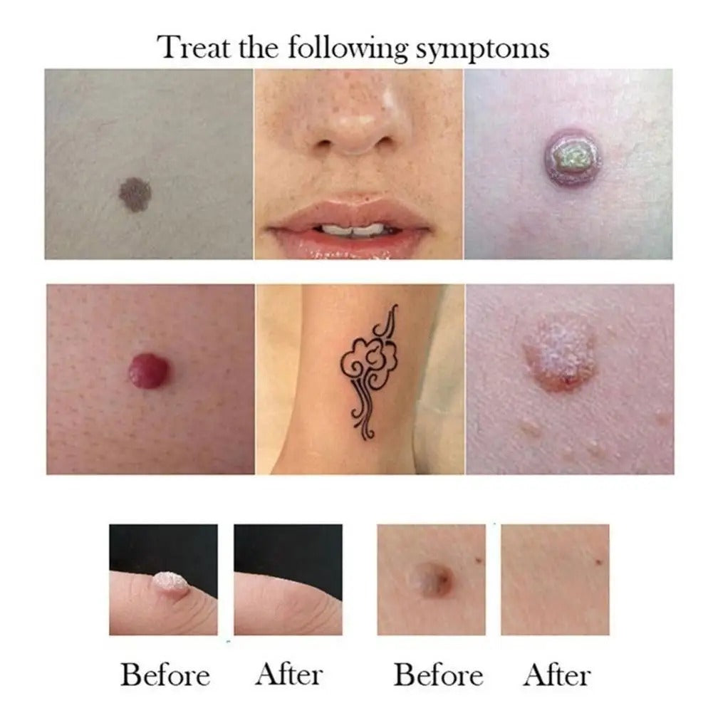 Dissolvant de taches brunes pour le corps, soin de la peau du visage