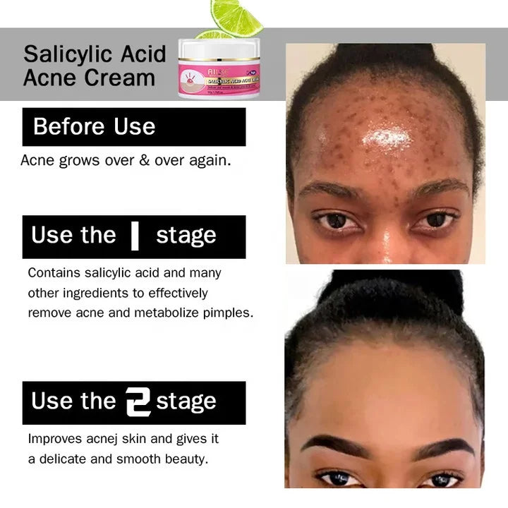 Crème Anti-Acné à l'Acide Salicylique Bio pour un Teint Pur et Rayonnant