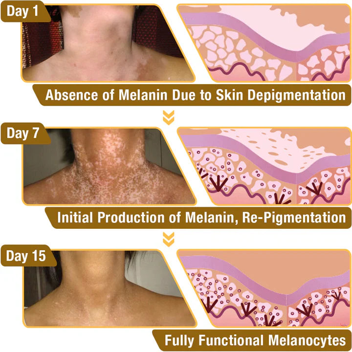 Fivfivgo™ Crème de traitement BeeVenom Vitiligo