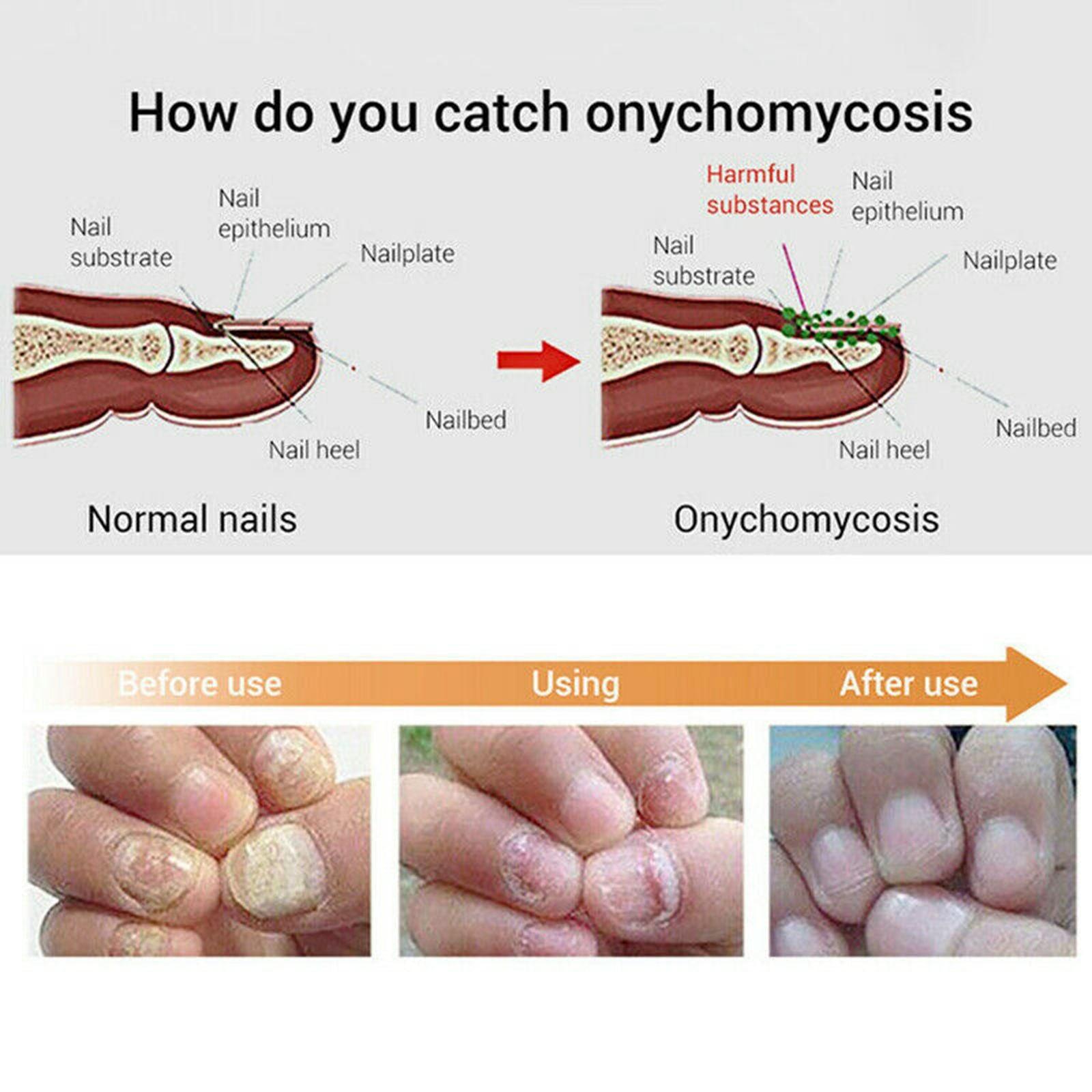 LANBENA-Sérum réparateur pour les ongles