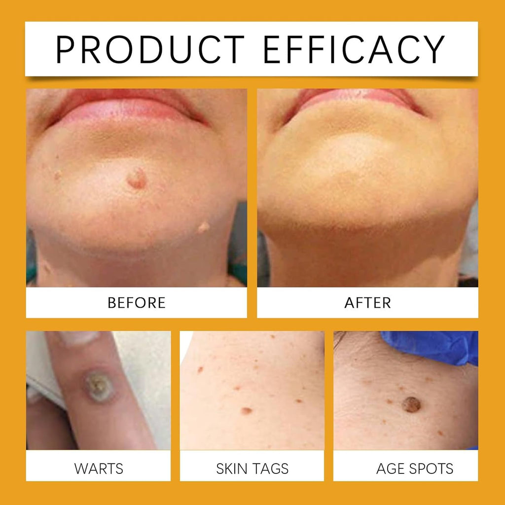 Crème au venin d'abeille, verrues au venin d'abeille, crème anti-verrues