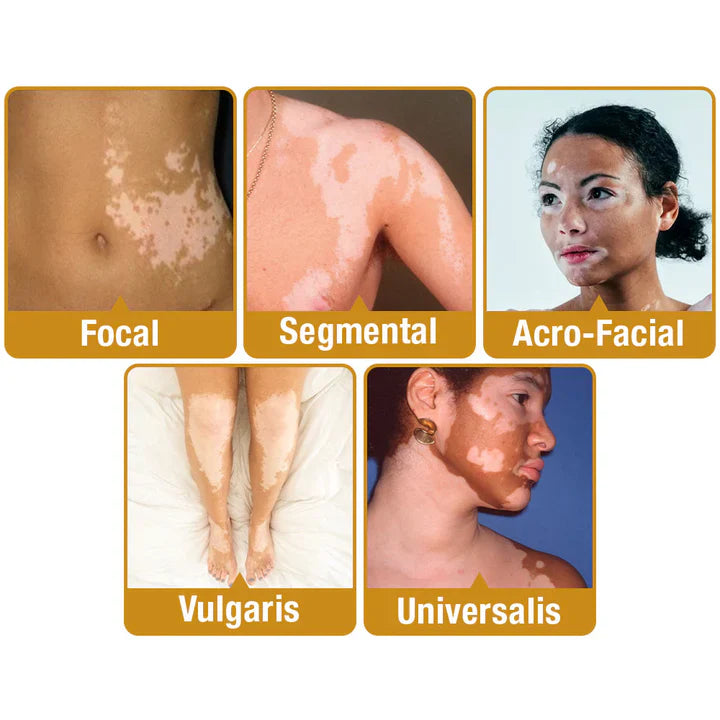 Fivfivgo™ Crème de traitement BeeVenom Vitiligo
