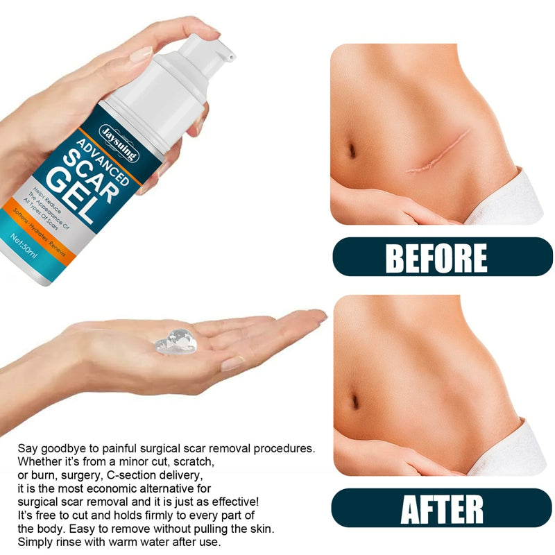 Crème pour l'Élimination des Cicatrices d'Acné