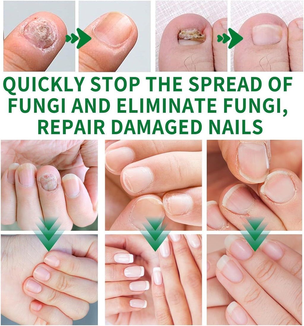 7 Days Fungus ® -(50 ml)