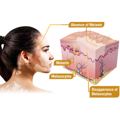 Fivfivgo™ Crème de traitement BeeVenom Vitiligo