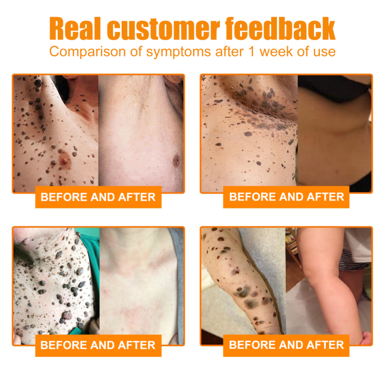 Crème de traitement contre les taupes et les verrues Brezey™ Bee Venom Mole