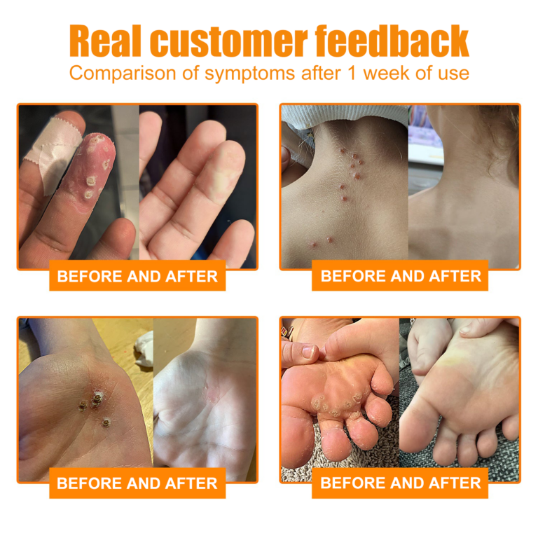 Crème de traitement contre les taupes et les verrues Brezey™ Bee Venom Mole