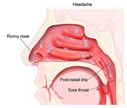 Nose Repair Device
