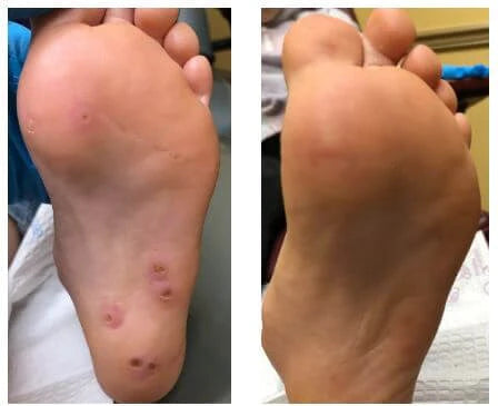 Dissolvant  d'acrochordons AEXZR™