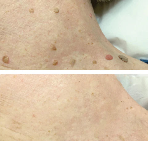 Dissolvant  d'acrochordons AEXZR™