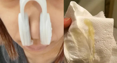 Nose Repair Device