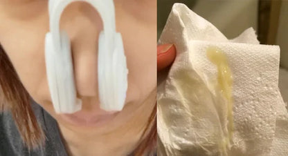 Nose Repair Device